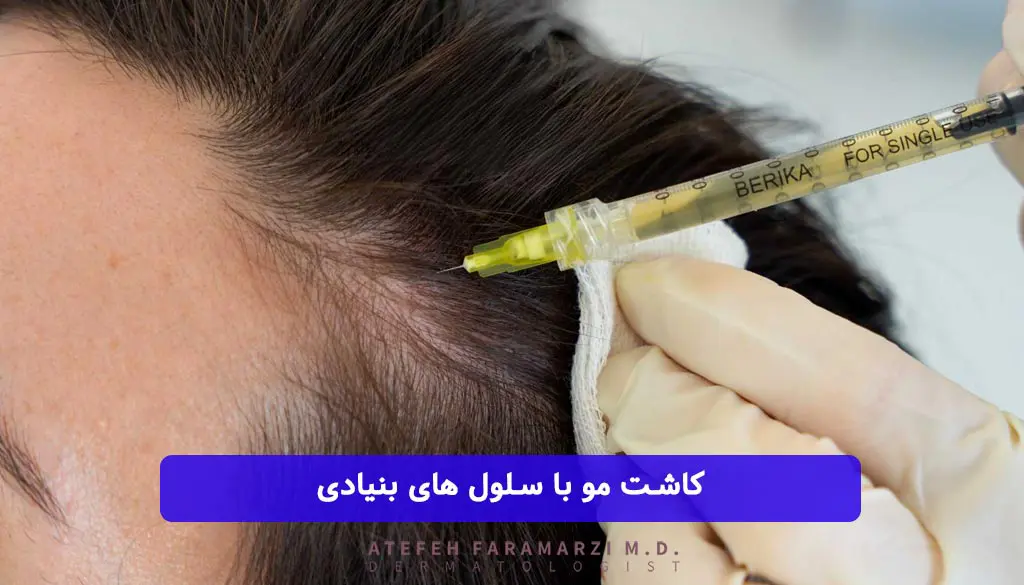 کاشت مو به روش سلول بنیادی