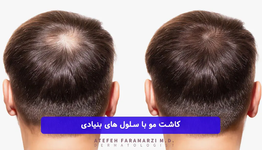 کاشت مو به روش سلول بنیادی