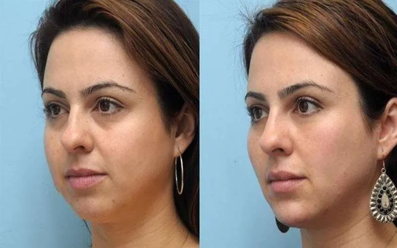 6 نکته موثر برای کاهش تورم و کبودی پس از عمل لیفت صورت